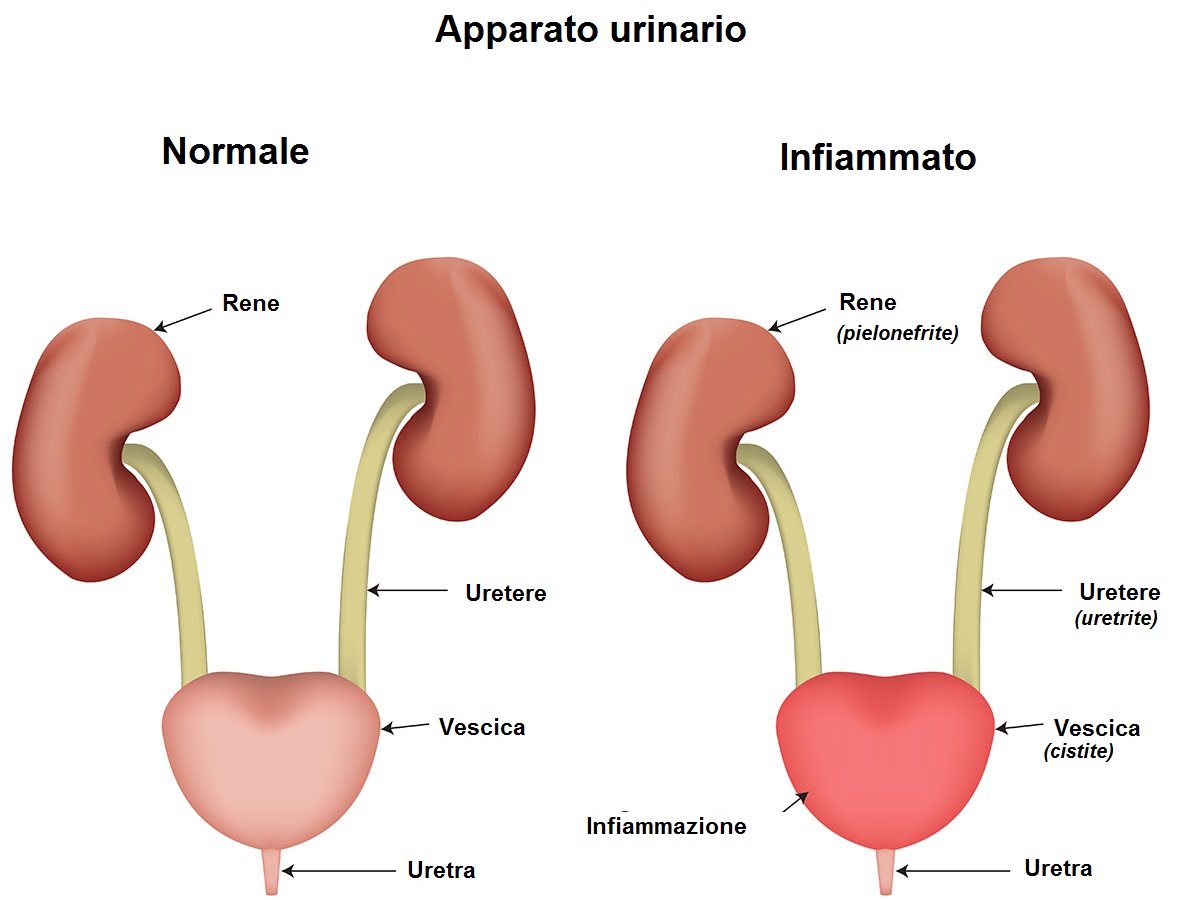 infezione urinaria cistite