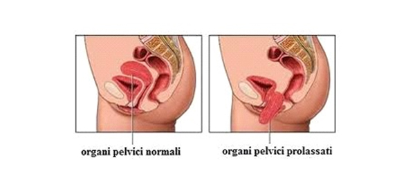 prolasso vaginale