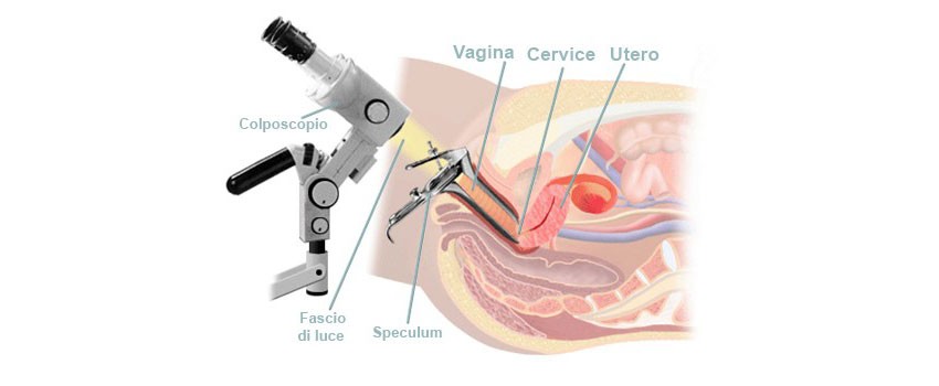 colposcopia esame ginecologico