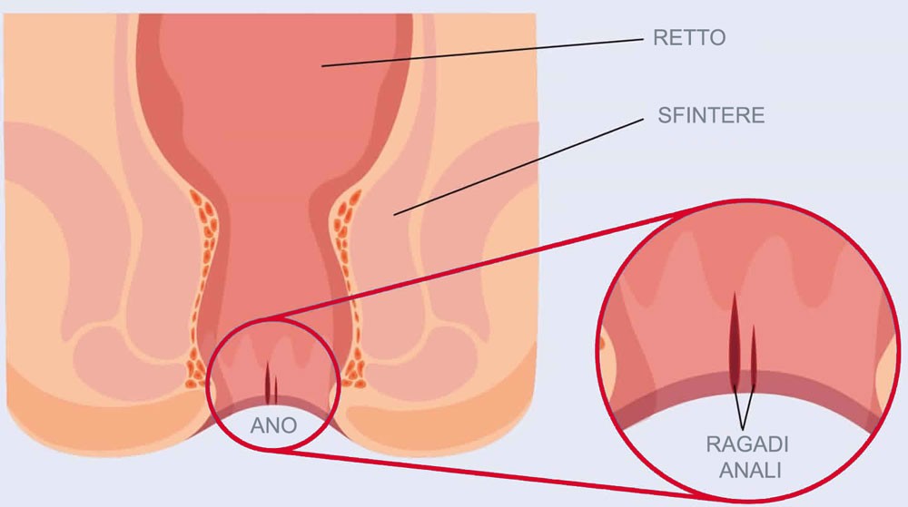 cura delle ragadi anali 