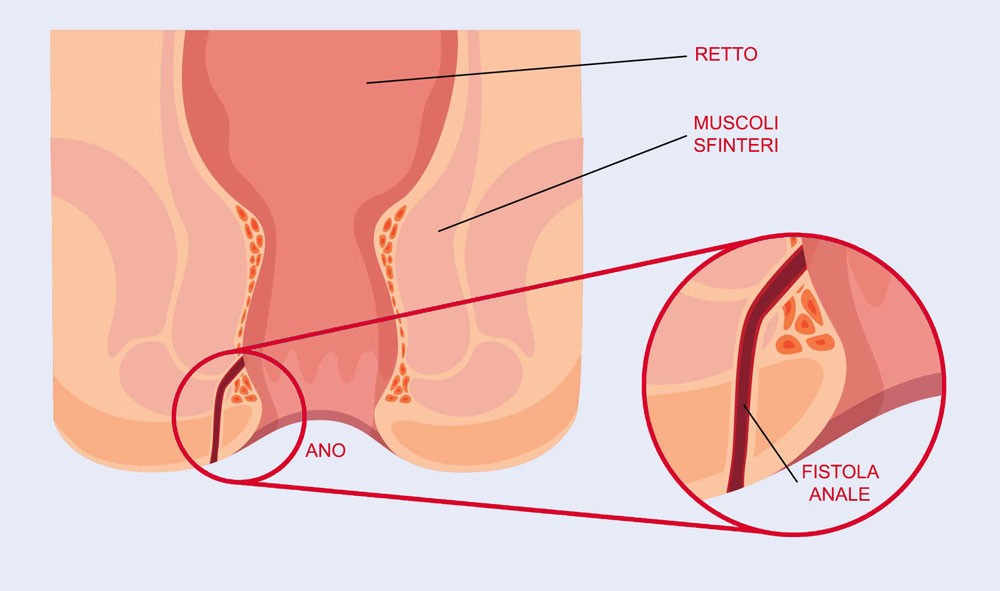 fistola anale diagnosi e trattamento