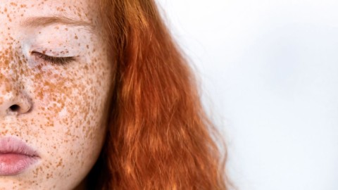 epiluminescenza videdermatoscopia centro medicobuonarroti su ragazza con lentiggini