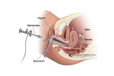 isterosonografia