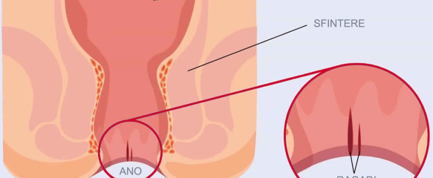 cura delle ragadi anali 