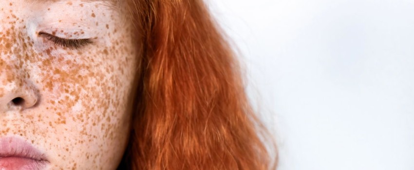 epiluminescenza videdermatoscopia centro medicobuonarroti su ragazza con lentiggini