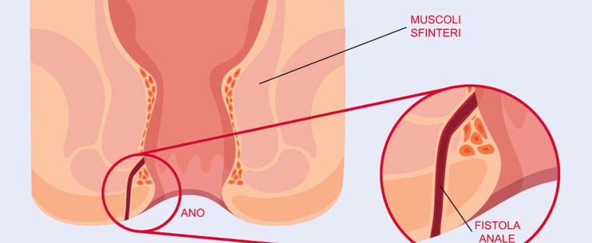 fistola anale diagnosi e trattamento