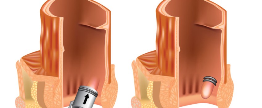 legatura elastica e scleroterapia emorroidi presso centro medico buonarroti